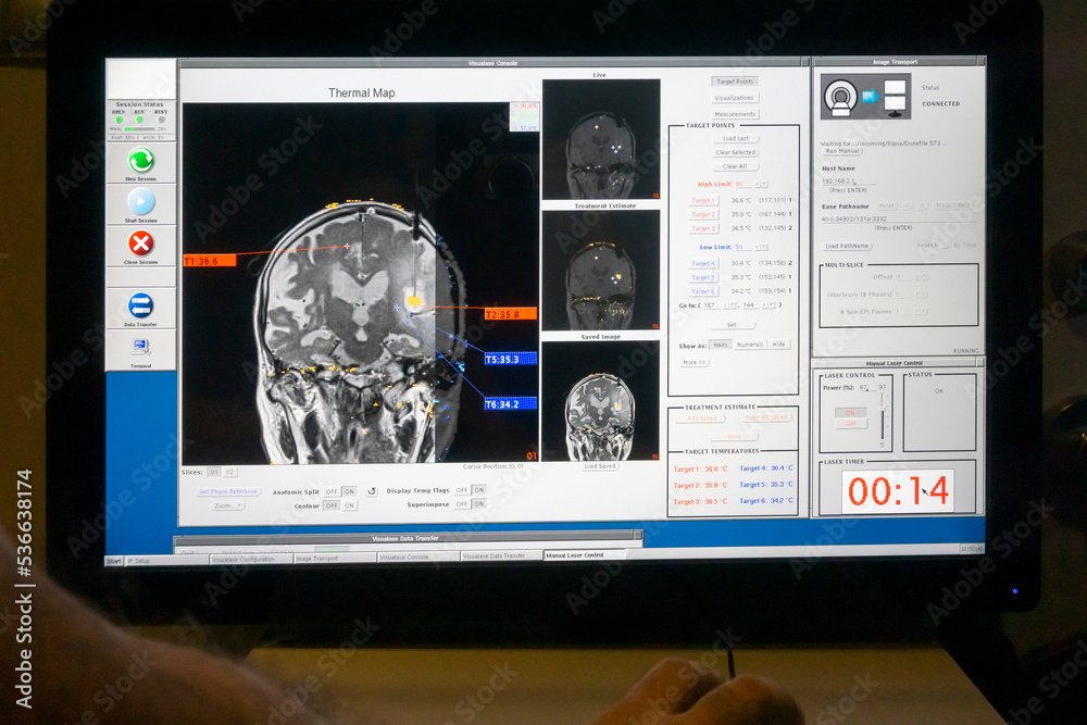 Step by step Visualase is an MRIguided laser ablation system used to