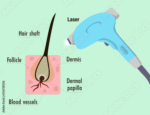 Laser hair removal. Depilation procedure. Device for shaving unwanted hair. Epilator. Hair structure