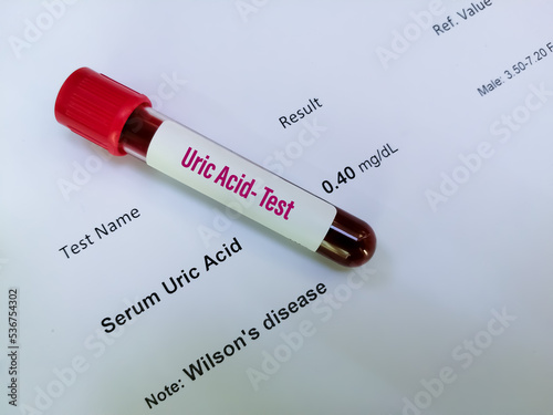 Blood sample isolated with abnormal low uric acid test result. Wilson's disease. photo