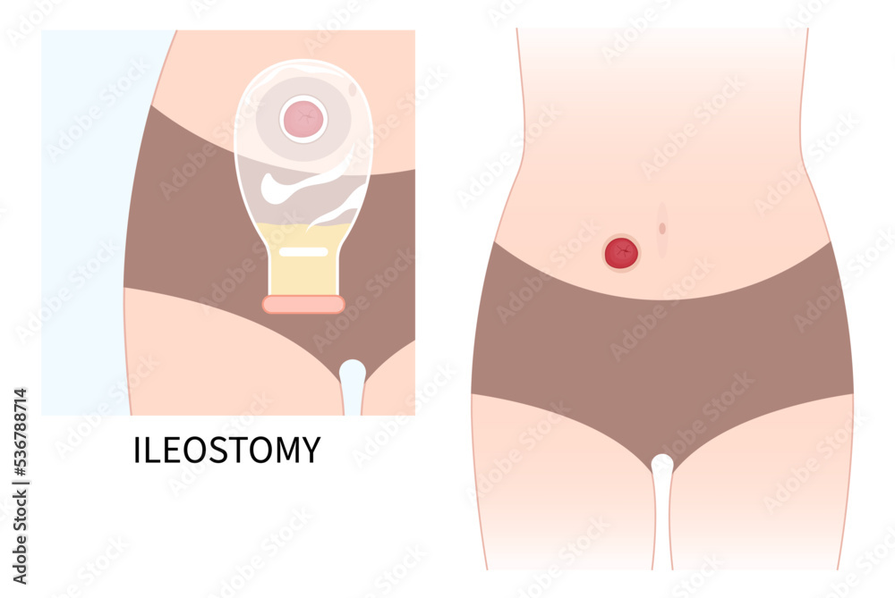 Obrázky Proctocolectomy – procházejte fotografie, vektory a videa 21 | Adobe  Stock