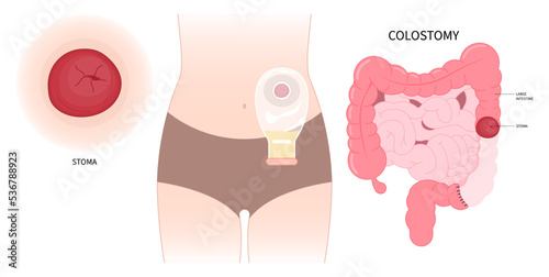 Left abdomen Pouch ileum Colon stoma removal Surgery with Tumor Small Large inflammation of Crohn and Hirschsprung disease blocked hernia Cancer to poo stool Loop invasive tract Rectal system photo