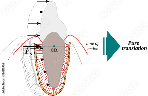 Center of resistance in a tooth and Translation or bodily movement