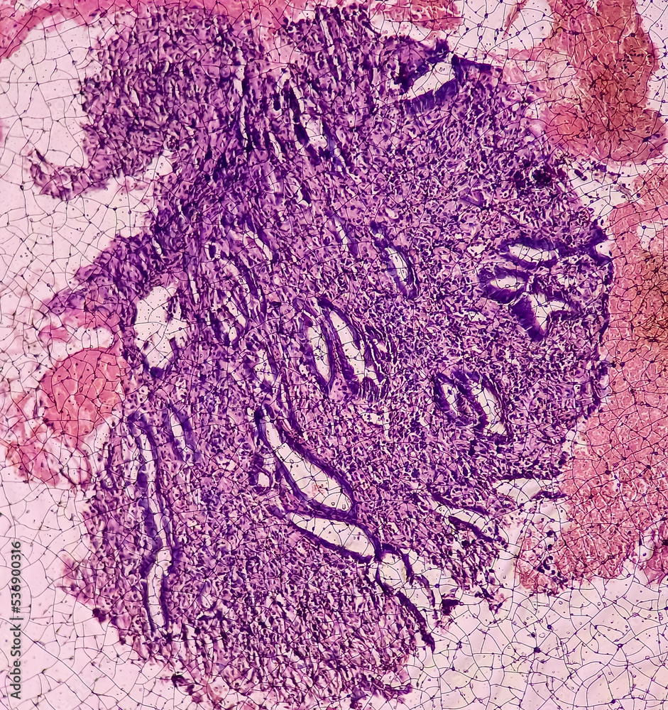 Tissue From Gastro jejunostomy Stomal Site endoscopic Biopsy Chronic tissue-from-gastro-jejunostomy-stomal-site-endoscopic-biopsy-chronic
