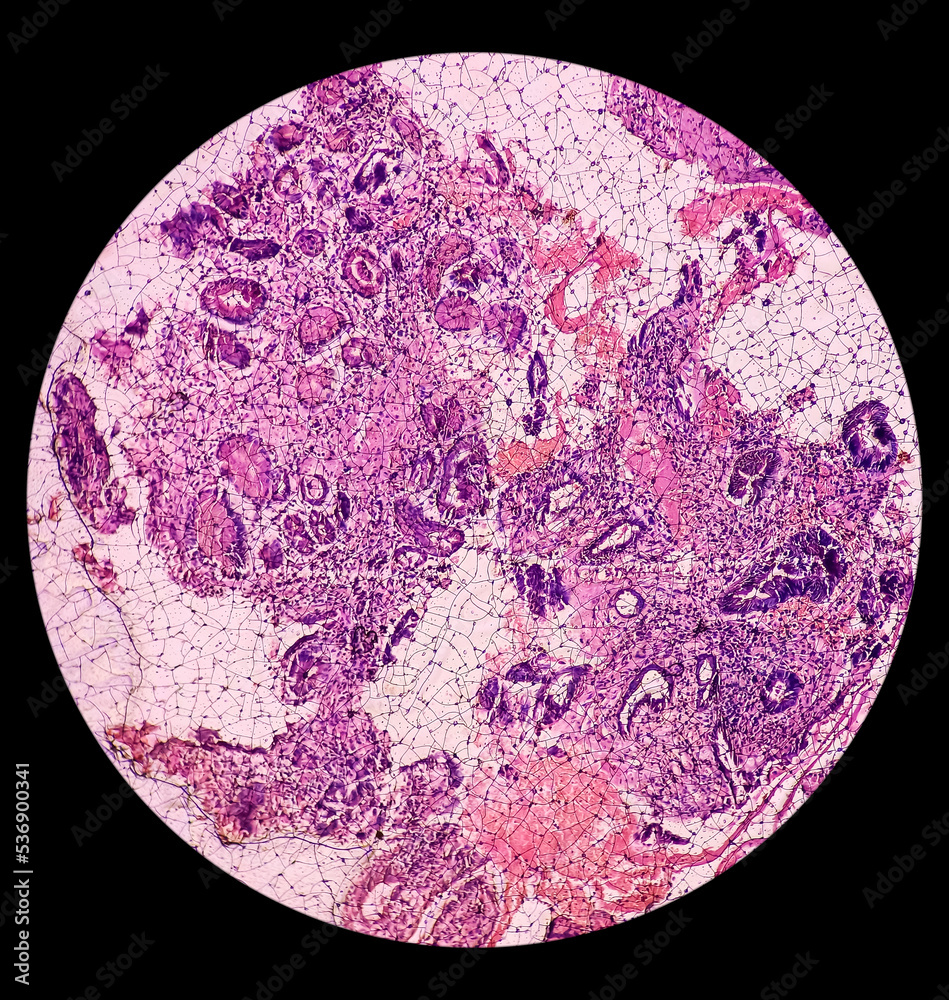 Tissue from gastrojejunostomy stomal site (endoscopic biopsy) Chronic