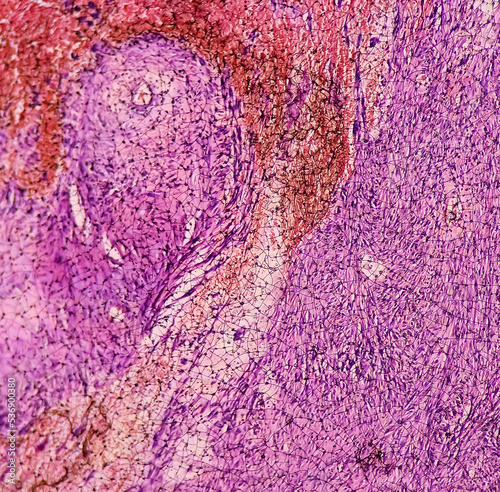 Small intestine mass(biopsy): Malignant gastrointestinal stromal tumor(GIST), Malignant peripheral nerve sheath tumor(MPNST), rare malignant mesenchymal lesion. Neurogenic sarcoma. photo