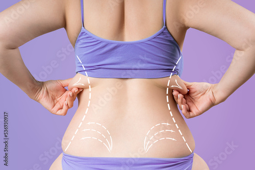 Back liposuction, fat and cellulite removal concept, overweight female body with painted surgical lines and arrows