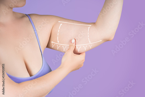Принти на полотні Hand liposuction, sagging flabby skin on a woman's arm, fat and cellulite remova