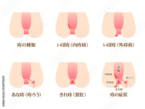 痔の症状の種類のベクター図解イラスト素材セット2