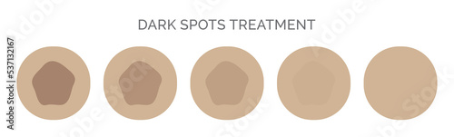 Dark Spots Removal Treatment Illustration