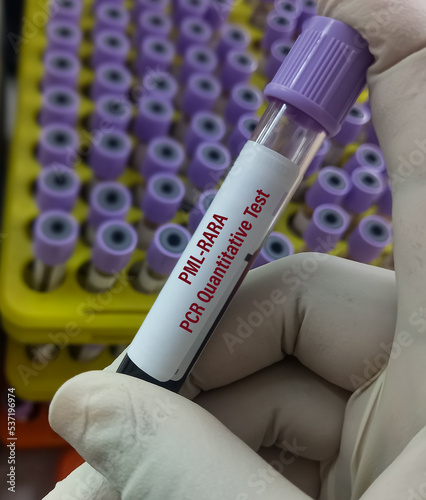 Blood sample for PML-RARA quantitative test in PCR laboratory. Acute promyelocytic leukemia (APL), a subtype of acute myeloid leukemia (AML). photo