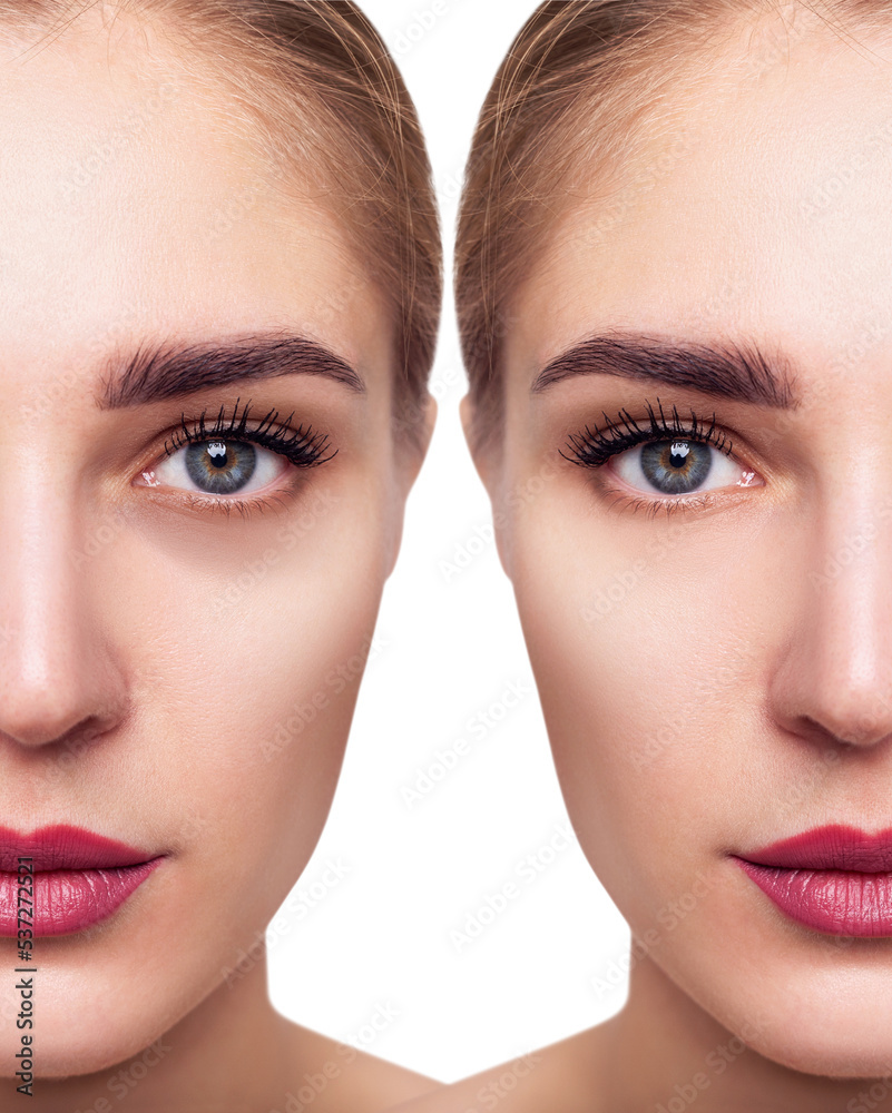 Young woman with bruises under eyes before and after treatment. Young woman with bruises under eyes before and after treatment.
