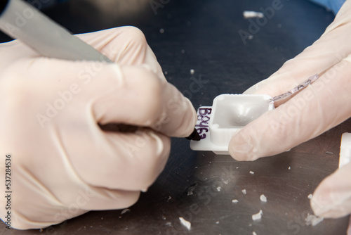 Scientist preparing paraffin blocks containing biopsy tissue for sectioning. Pathology laboratory. Cancer diagnosis.