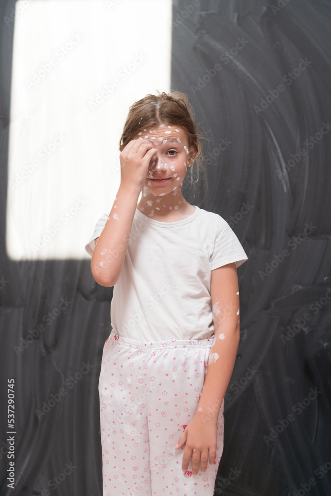 Portrait of a little school girl with chickenpox, antiseptic cream applied to face and body .Colorful background. Portrait of a little school girl with chickenpox, antiseptic cream applied to face and body .Colorful background.