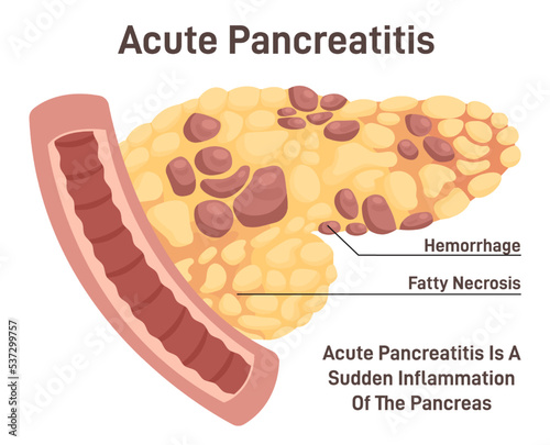 Pancreatitis disease. Pain and inflammation in human internal
