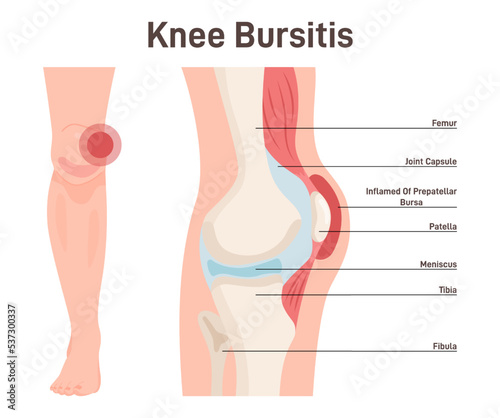 Bursitis. Knee joint inflammation. Inflamed or irritated bursae of synovial