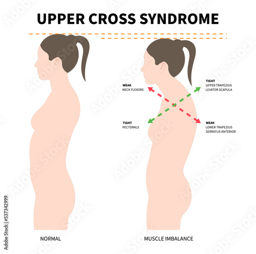 upper cross syndrome with trapezius and dowager’s painful spinal of Scheuermann's rounded Disk body poor Postural care anterior pelvic tilt