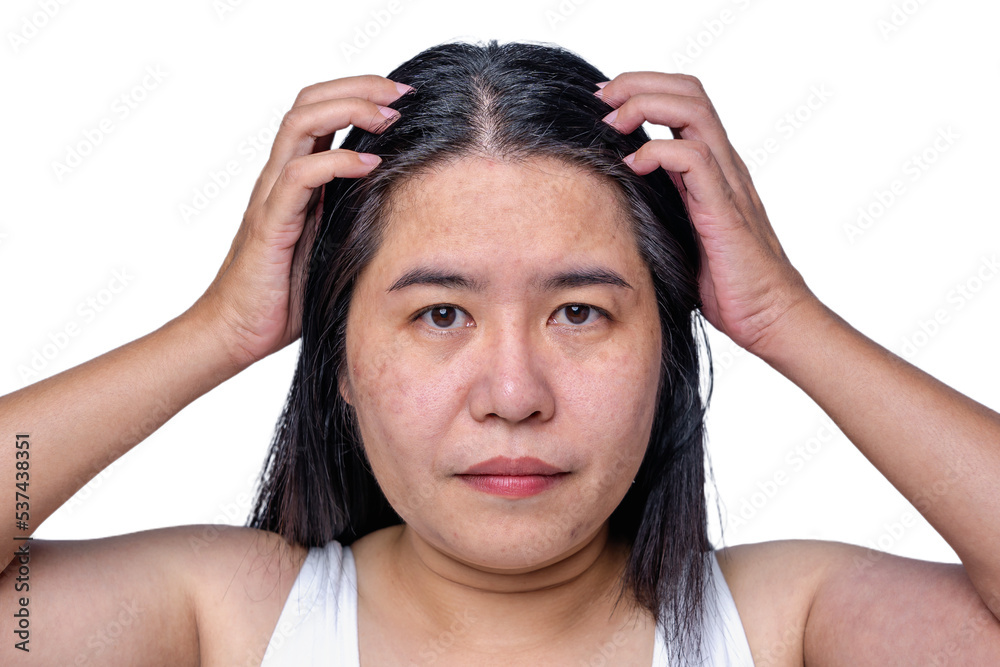 Asian adult woman face has freckles, large pores, blackhead pimple and scars problem from not take care for a long time. Skin problem face isolated white background. Treatment and Skincare concept