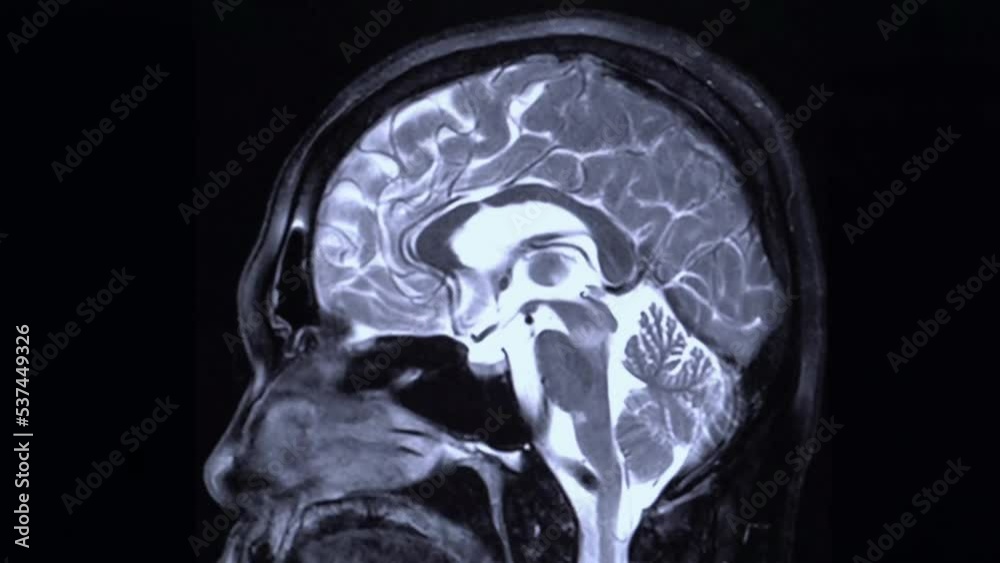 close up MRI of the brain sagittal plane cysts tumors bleeding swelling ...