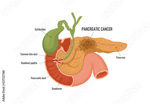 Pancreas cancer. Human cancer, medical illustration