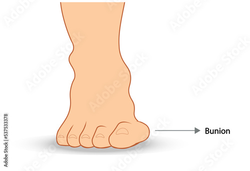 Bunion illustration. Frontal view of a foot with a bunion. Hallux Valgus