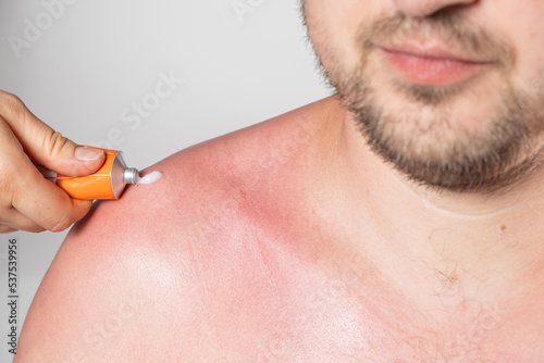 Applying therapeutic ointment to the skin of a person with a sunburn, close-up. photo