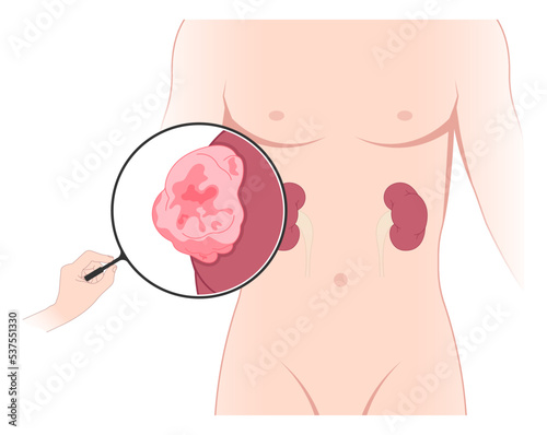 kidney cancer disease with Laparoscope donation minimally invasive surgery of Nephrectomy swelling organ artery tract stenosis