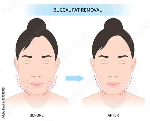 Before and after Cheek buccal fat removal with augment excess slim face of Bichat’s procedure photo