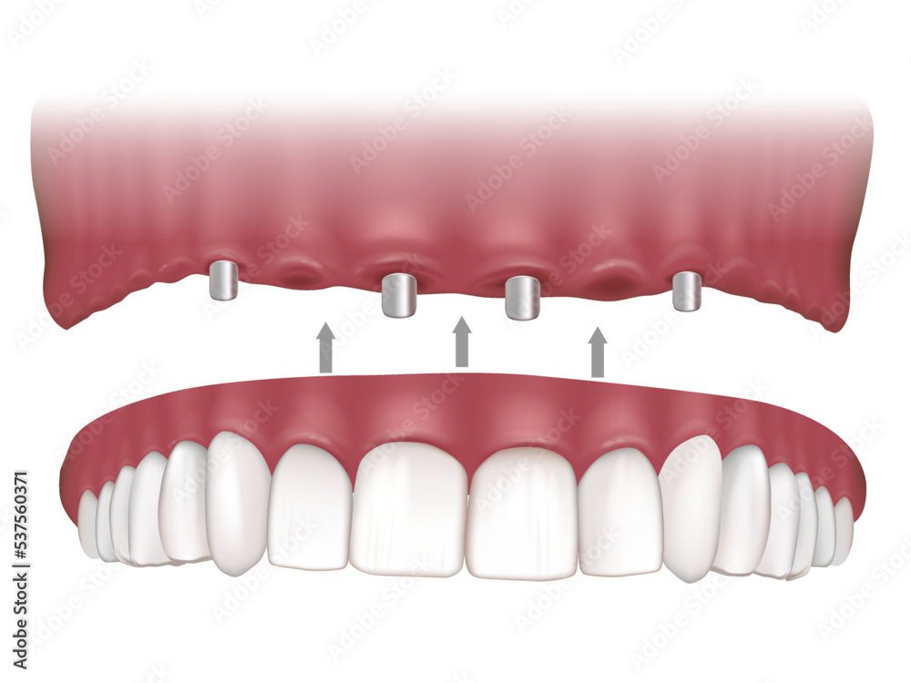 Maxillary Implant Supported Fixed Prosthesis. Maxillary overdentures supported by four implants