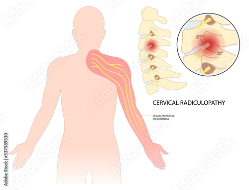 Tingling Numbness hand of spine degeneration thoracic neck root injury outlet pain damage canal syndrome Herniation traumatic bone disk spurs painful Spinal cord pinched nerves