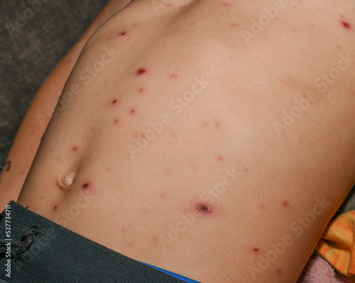 Chickenpox on the body of a child, Severe chicken pox crusts on rashes. papules and blisters. photo