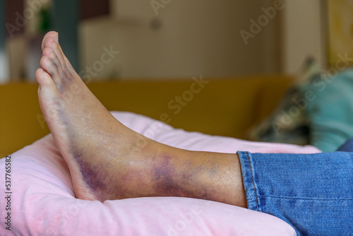 Sprained and bruised ankle in rest seen from the side