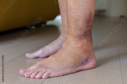 Two feet of which one has a bruised sprained ankle.