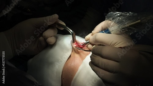 Crop doctors doing piezo rhinoplasty surgery photo