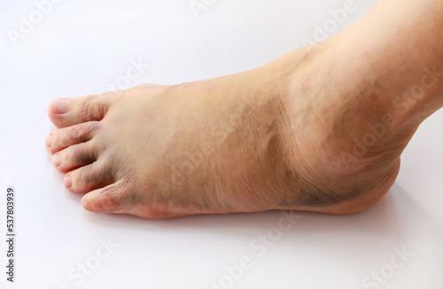Left foot bruise or contusion and swollen cause by injury
