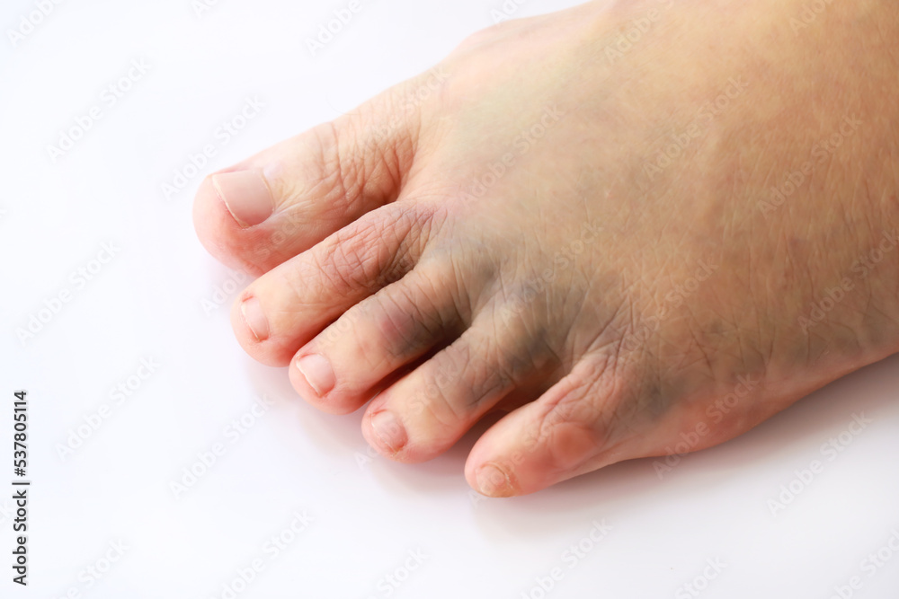 Left foot bruise or contusion and swollen cause by injury Left foot bruise or contusion and swollen cause by injury