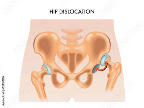 Medical illustration of the hip dislocation. photo