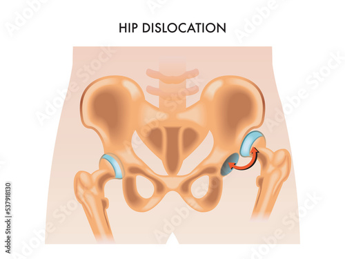 Tablou pe pânză Medical illustration of the hip dislocation.