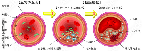 動脈硬化　経過　イラスト