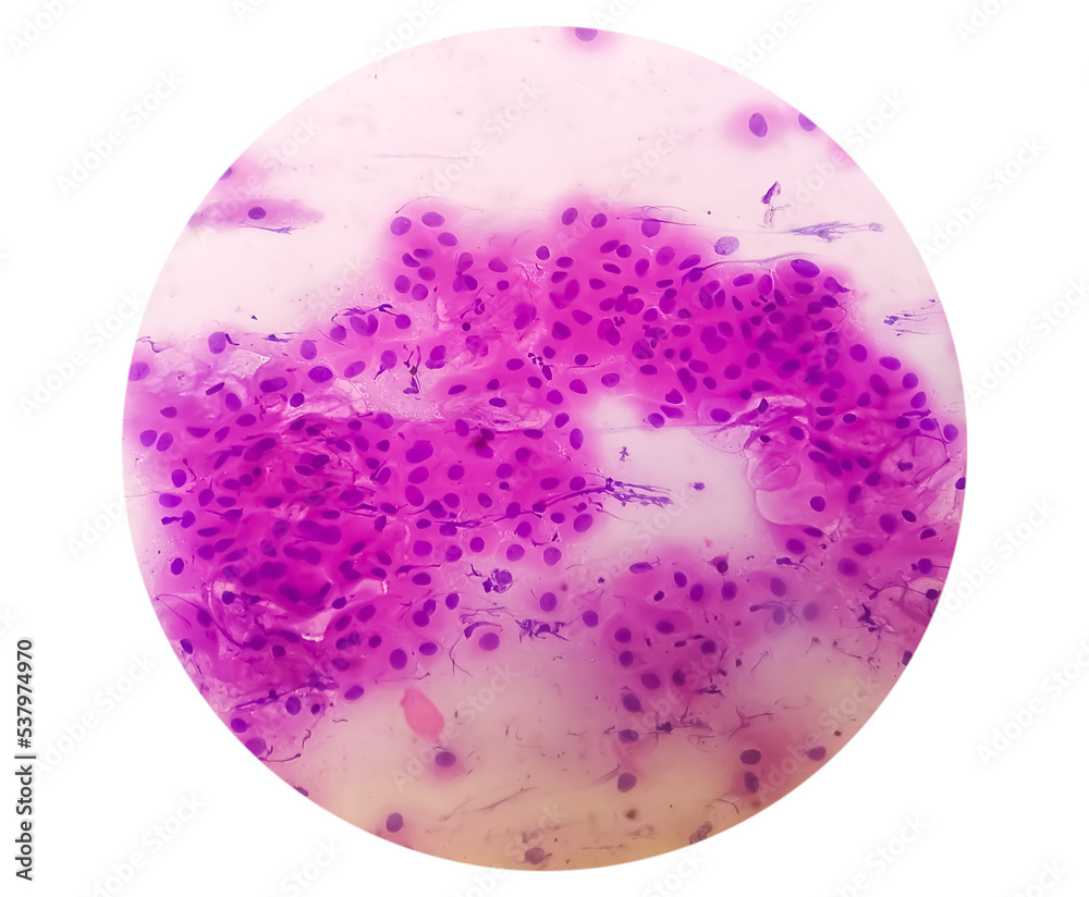 Pap's smear pap stain Microscopic 40x Zoom show High-grade squamous intraepithelial lesion is a pre-cancerous, sexually transmitted disease Pap's smear pap stain Microscopic 40x Zoom show High-grade squamous intraepithelial lesion is a pre-cancerous, sexually transmitted disease