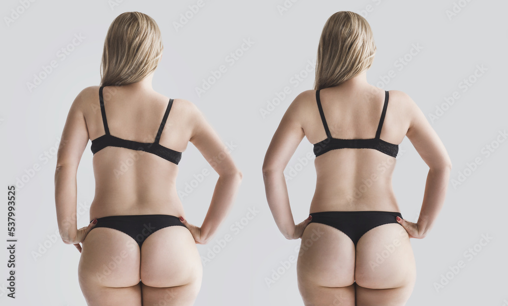 Woman's back before and after treatment. Curvature of the spine, one
