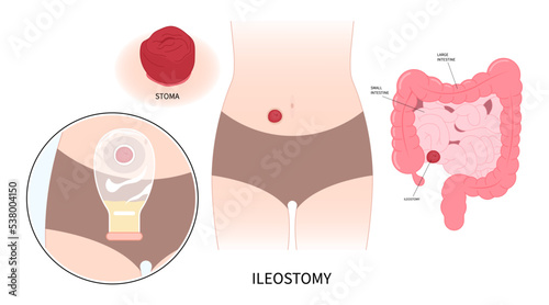 Large Colon removal with stoma Pouch Surgery on abdomen for Small Crohn and Hirschsprung poo stool disease blocked inflammation hernia Cancer tract Rectal system ileum Tumor Loop invasive