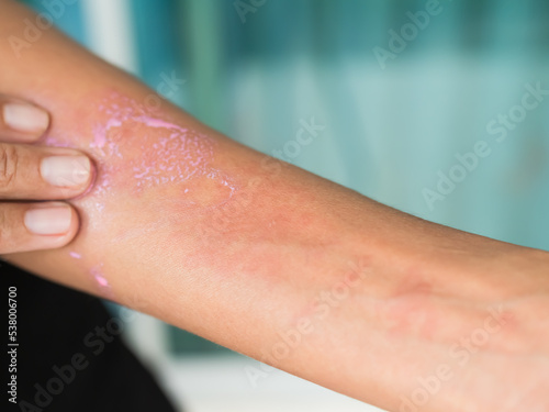 Urticaria on hand woman non-lethal type from food and air poisoning. she apply Calamine Lotion medicine on the arm her.she Sick, have an allergic reaction. Urticaria on skin body.healthcare concept.