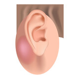 Mastoiditis. Inflammatory disease of the ear. Medical poster vector illustration