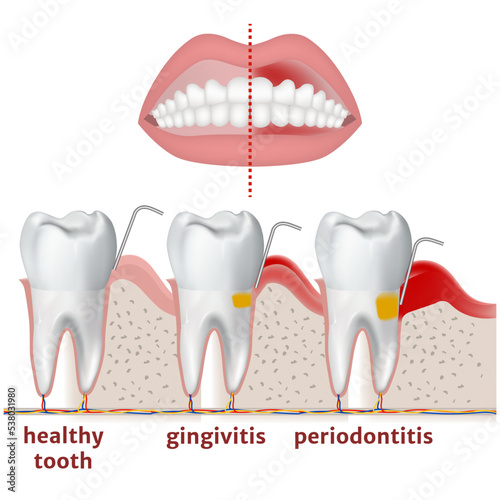 periodontitis and gingivitis. Diagram with disease of teeth and gums. Medical poster vector illustration photo