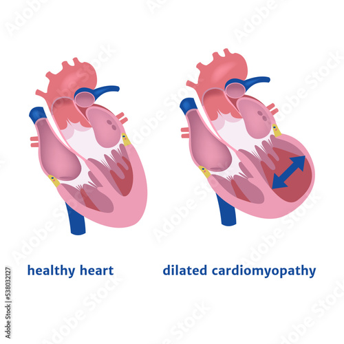 dilated cardiomyopathy. Expansion of the ventricle of the heart. Medical poster vector illustration photo