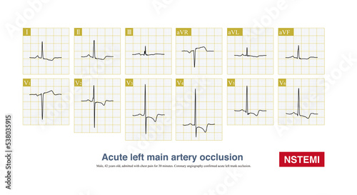 Photography Acute left main artery occlusion can cause both ST segment elevation and non ST segment elevation myocardial infarction, regardless of which type, the risk of death is high