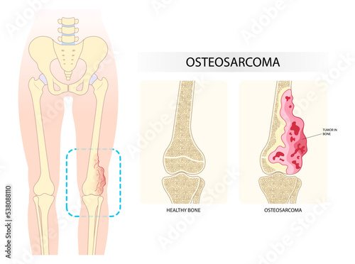 The chondrosarcoma and Ewing's sarcoma tumor cell with hip femur gross leg bone pain and soft tissues gene mutation chromosomal inflammation by needle transplant photo