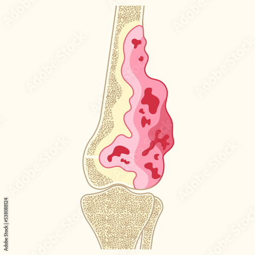 The chondrosarcoma and Ewing's sarcoma tumor cell with hip femur gross leg bone pain and soft tissues gene mutation chromosomal inflammation by needle transplant photo