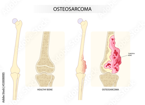 tumor cell with hip femur with The Ewing's sarcoma gross leg bone pain and soft tissues gene mutation chromosomal inflammation of chondrosarcoma by needle transplant photo