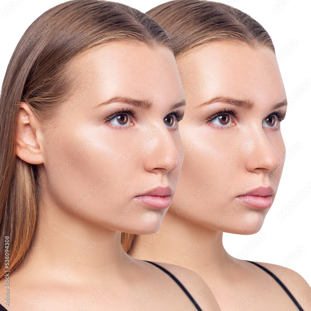 Portrait of female nose before and after plastic surgery. Portrait of female nose before and after plastic surgery.